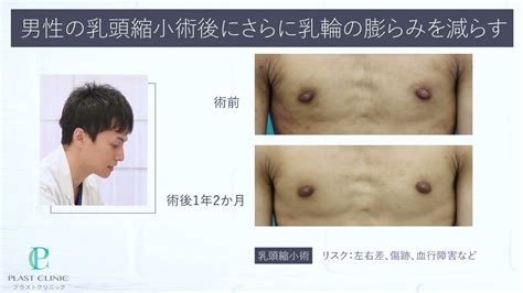 男 乳首 大きい|【症例写真】男性の乳頭縮小手術の症例：美容外科 高須クリニック.